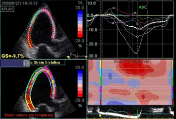 Image: Representation of 2D-strain (speckle tracking) of the left ventricle in the apical long axis view in a patient with systolic heart failure (Photo courtesy of SPL). Image: Representation of 2D-strain (speckle tracking) of the left ventricle in the apical long axis view in a patient with systolic heart failure (Photo courtesy of SPL).